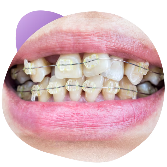 Brackets estéticos cerámicos en Nezahualcóyotl