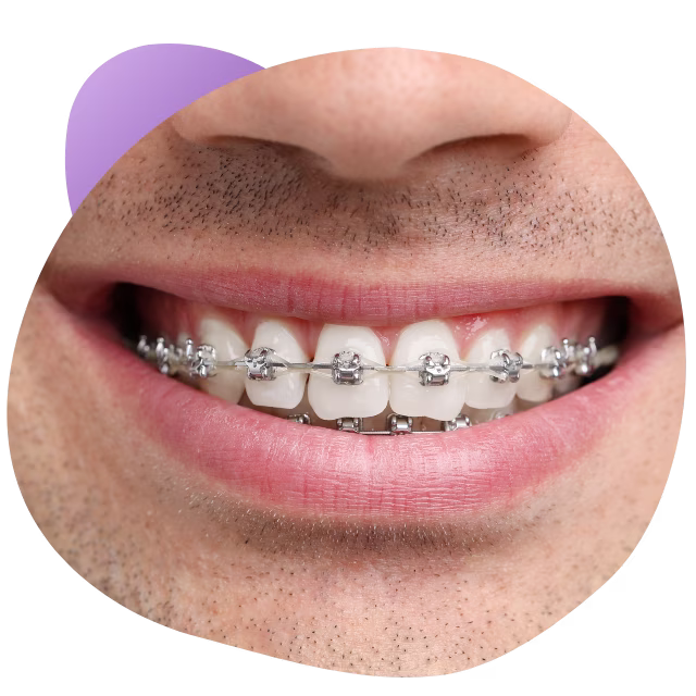 Brackets metálicos en Nezahualcóyotl para apiñamiento dental severo