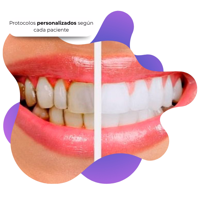 Dientes flojos por periodontitis en Nezahualcóyotl