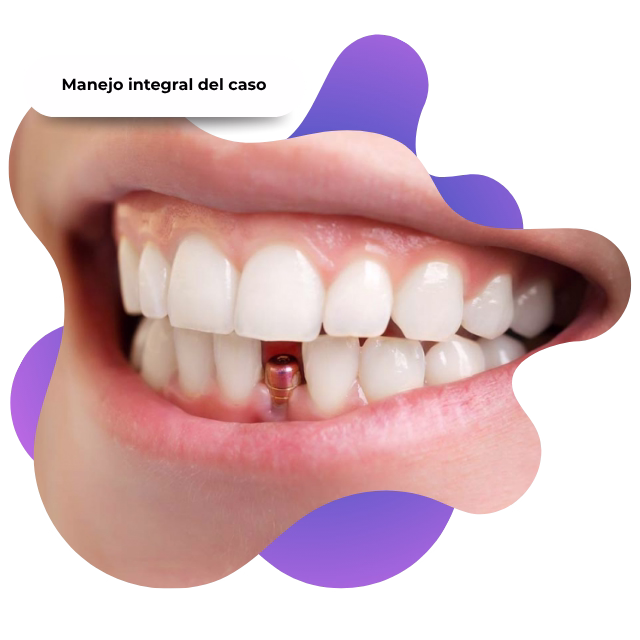 Cuidado de prótesis removible vs implantes en Nezahualcóyotl