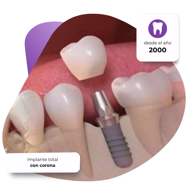 Proceso de implantes dentales en Nezahualcóyotl