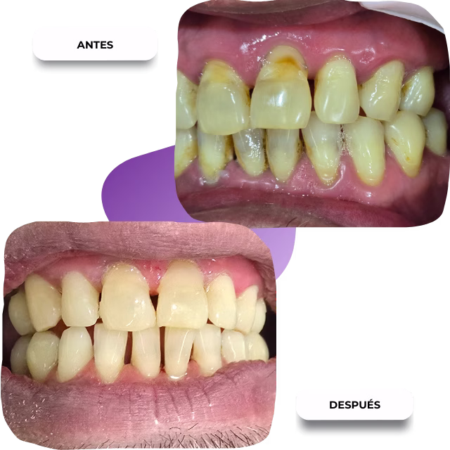 Limpieza dental sin dolor ni sensibilidad en Nezahualcóyotl