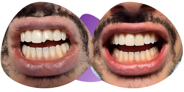 Testimonios de implantes dentales Nezahualcóyotl con Miguel