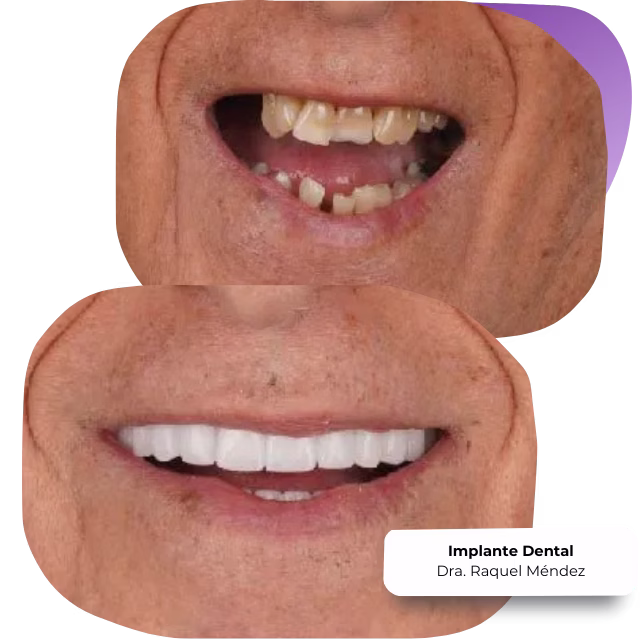 Especialista en implantes dentales Nezahualcóyotl Dra. Raquel Méndez