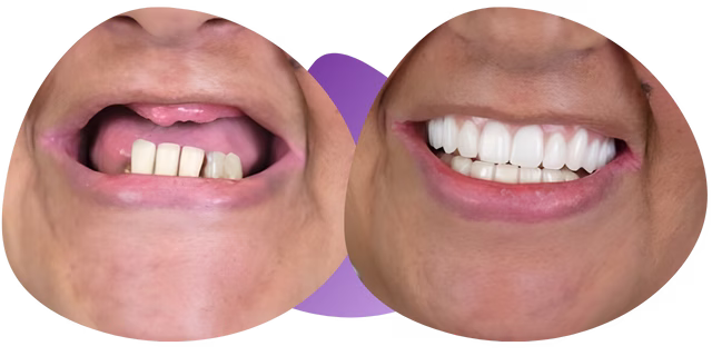 Testimonios de implantes dentales Nezahualcóyotl con Rosa