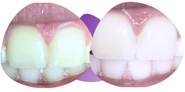 Testimonio de limpieza dental Nezahualcóyotl con la Dra. Raquel Méndez de Miguel