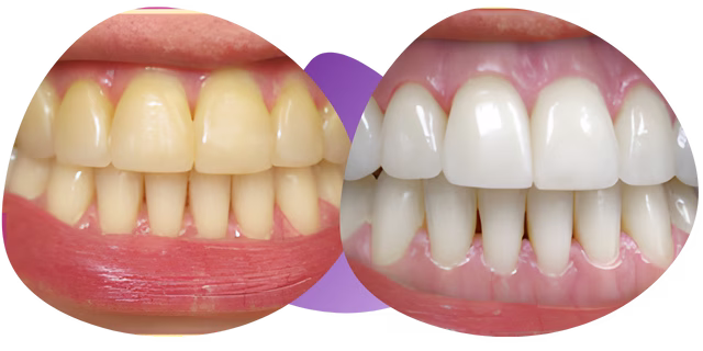 Testimonio de limpieza dental Nezahualcóyotl con la Dra. Raquel Méndez de Ximena