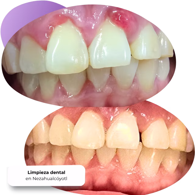 Eliminación de sarro acumulado en dientes en Nezahualcóyotl
