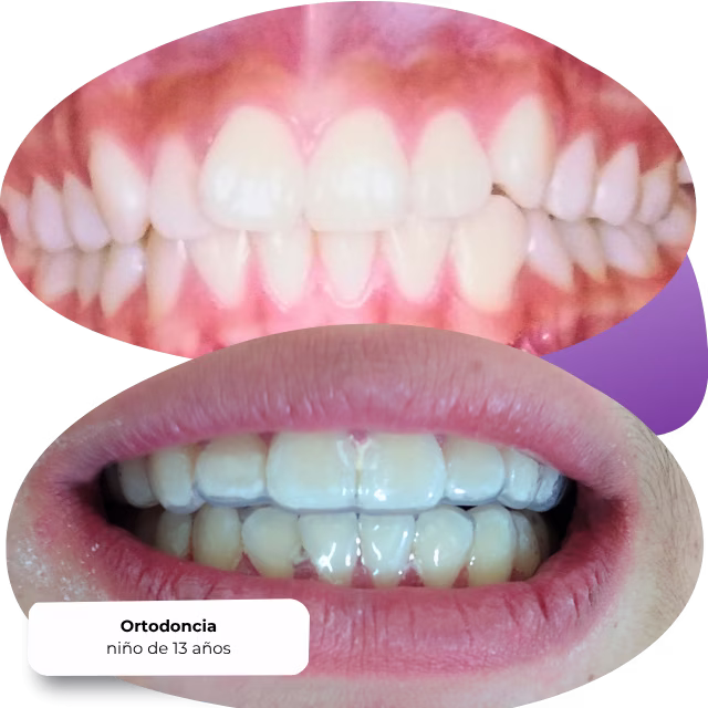 Ortodoncia realizada en Servicios Dentales Especializados de Nezahualcóyotl