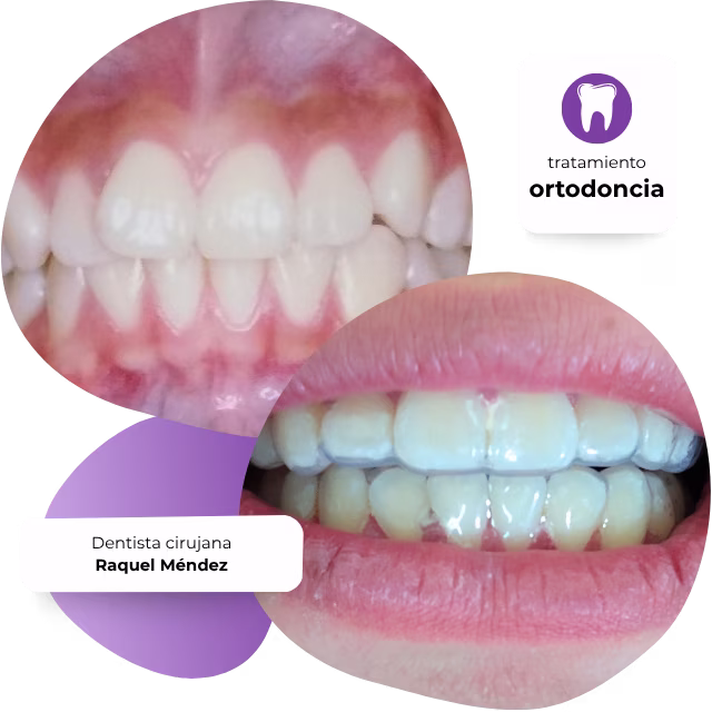Ortodoncia en Nezahualcóyotl con la Dra. Raquel Méndez