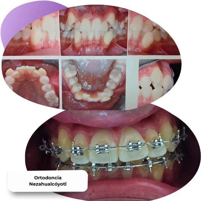 Ortodoncia sin dolor con tecnología láser dental Nezahualcóyotl