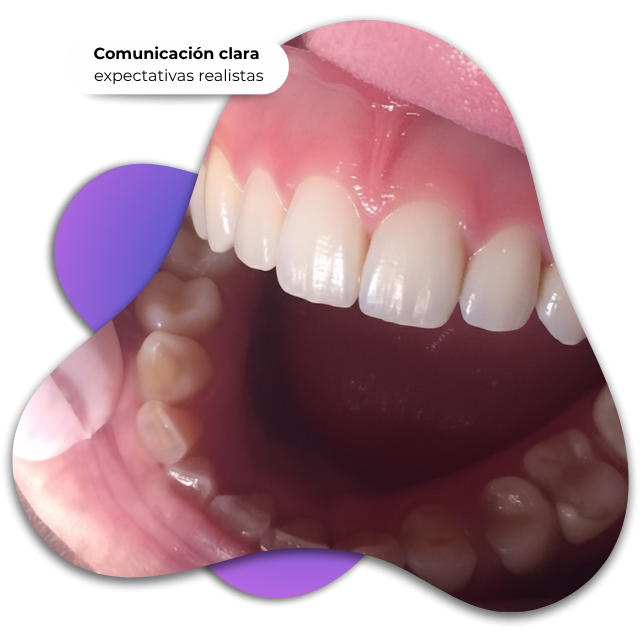 Implantes dentales sin dolor en Nezahualcóyotl