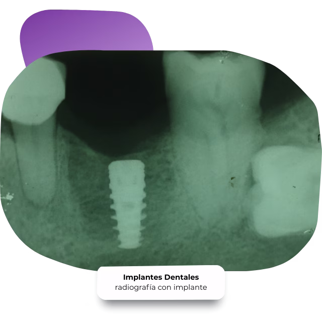 Implantes dentales en Nezahualcóyotl con la Dra. Raquel Méndez